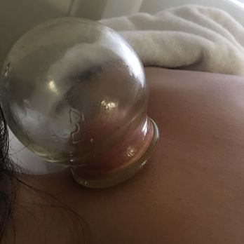 WZ Clinic - Cupping - Acupuncture Near Me - Redwood City, California WZ Clinic - Cupping - Acupuncture Near Me - Redwood City, California