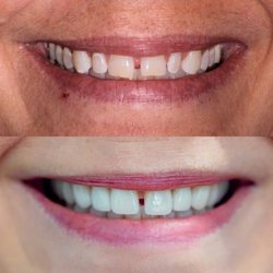 Dental Studio West - Before and after dental results at Dental Studio West! Dentist in Cincinnati, OH.