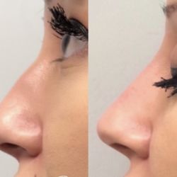 Bellina Medical Aesthetics - Non-surgical nose job