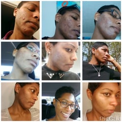Advanced Dermatology & Cosmetic Center - Acne progress thanks to Dr. Edwards. Initial visit and pic is in March 2015 and last visit October 2015.