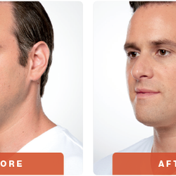 Newport Medical & Wellness - Kybella Before and After