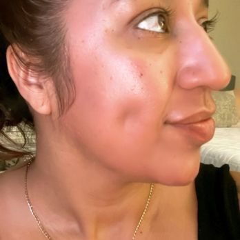 LaserAway - Medical Spas Near Me - Hermosa Beach, California LaserAway - Medical Spas Near Me - Hermosa Beach, California