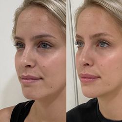 Bajwa Aesthetics - Lips and Chin Filler