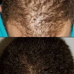 Crown Clinic - Men's hair loss treatments