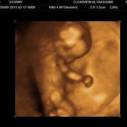 Clearview Ultrasound - Our U/S at 15 weeks.