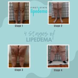 Dr. Shapira - First State Lipedema