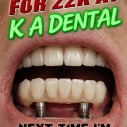 KA Dental - Do these look like 22K implants?