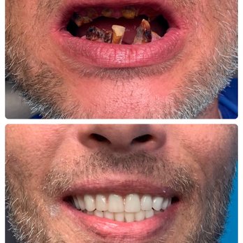 Affordable Dentures & Implants - This is before and after Mini Dental Implants. - General Dentistry Near Me - Charleston, South Carolina Affordable Dentures & Implants - This is before and after Mini Dental Implants. - General Dentistry Near Me - Charleston, South Carolina