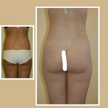Shahin Javaheri, MD - Liposuction / Liposculpting - Cosmetic Surgeons Near Me - San Francisco, California Shahin Javaheri, MD - Liposuction / Liposculpting - Cosmetic Surgeons Near Me - San Francisco, California