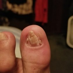 Jared Moon, DPM - Toe #2 Post surgery