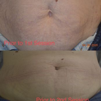 Exclusively Glamorous - Faded Stretch Marks utilizing PRP - Medical Spas Near Me - Prescott Valley, Arizona
