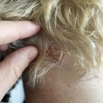 Bella on villa salon - Deep chemical burns on skin - Hair Salons Near Me - Mountain View, California Bella on villa salon - Deep chemical burns on skin - Hair Salons Near Me - Mountain View, California