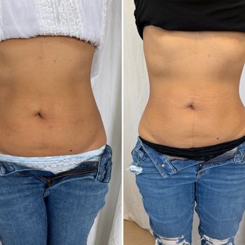 Soul Body Studio - Before in the left at 39.5" and on the right at 29". - Skin Care Near Me - Pasadena, California Soul Body Studio - Before in the left at 39.5" and on the right at 29". - Skin Care Near Me - Pasadena, California
