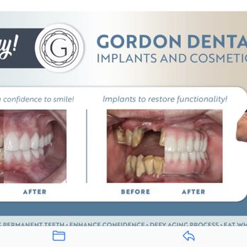 Gordon Dental Implants and Cosmetics - Before and after - Cosmetic Dentists Near Me - Leawood, Kansas Gordon Dental Implants and Cosmetics - Before and after - Cosmetic Dentists Near Me - Leawood, Kansas