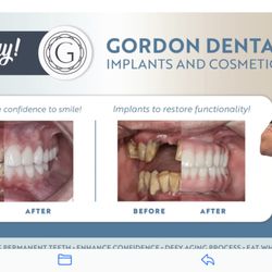 Gordon Dental Implants and Cosmetics - Before and after