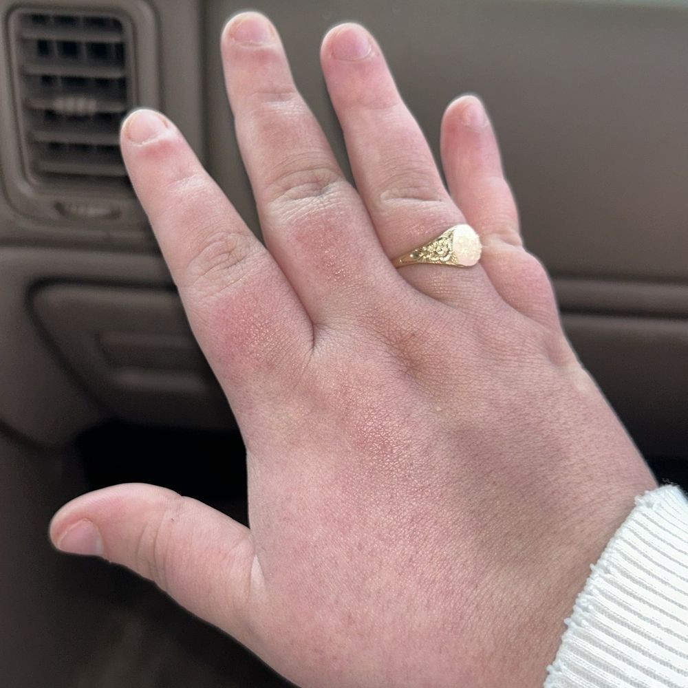 The hand that got tanned The hand that got tanned