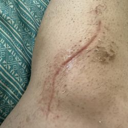 Sarah Blumenthal, MD - Keck Medicine of USC - Surgery scars after 2 months