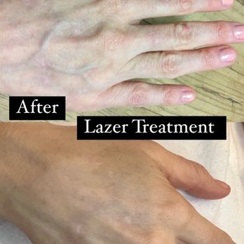 Platinum Image Services - Laser treatment on hands just one treatment great results - Eyelash Service Near Me - Beverly Hills, California Platinum Image Services - Laser treatment on hands just one treatment great results - Eyelash Service Near Me - Beverly Hills, California