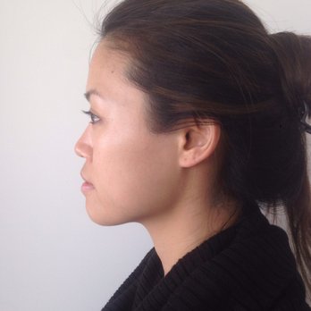 Del Rey Face  - Before any filler was injected. Notice the bridge between my eyes is flat. - Cosmetic Surgeons Near Me - Marina Del Rey, California