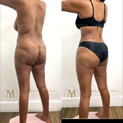 Michael J Yoo, MD - Tummy Tuck & Lipo 360 by Dr. Michael J. Yoo, MD - Double Board Certified Plastic Surgeon
