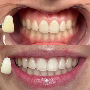 The Coco Blanc Teeth Whitening - Teeth Whitening Near Me - Costa Mesa, California The Coco Blanc Teeth Whitening - Teeth Whitening Near Me - Costa Mesa, California