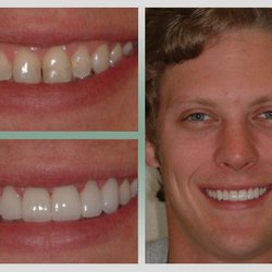 Smile Makeover