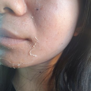 Chic la Vie Med Spa - My pores around my nose seem smaller. - Skin Care Near Me - Las Vegas, Nevada Chic la Vie Med Spa - My pores around my nose seem smaller. - Skin Care Near Me - Las Vegas, Nevada