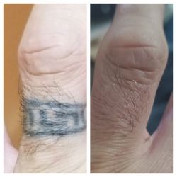 First Class Tattoo Removal Service - Before treatment after 5 treatments