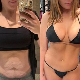 Before and after tummy tuck, breast lift, breast augmentation and liposuction preformed by Dr. Minniti. Before and after tummy tuck, breast lift, breast augmentation and liposuction preformed by Dr. Minniti.