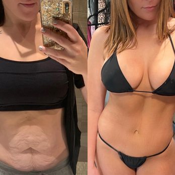 Gerald Minniti, MD, FACS - Before and after tummy tuck, breast lift, breast augmentation and liposuction preformed by Dr. Minniti. - Plastic Surgeons Near Me - Beverly Hills, California Gerald Minniti, MD, FACS - Before and after tummy tuck, breast lift, breast augmentation and liposuction preformed by Dr. Minniti. - Plastic Surgeons Near Me - Beverly Hills, California