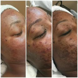 She's Rare Beauty Bar - CORRECTIVE SKIN CARE ACNE FACIALS ! Consistency is KEY 3 months !