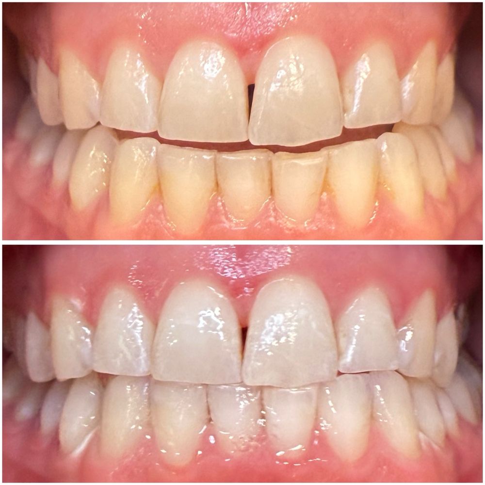 Deebeaut - Results - Teeth Whitening Near Me Deebeaut - Results - Teeth Whitening Near Me
