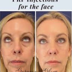 Gorgeous Glow Aesthetics - PRF! Your own growth factor taken from your blood! Natural, safe, guaranteed results.