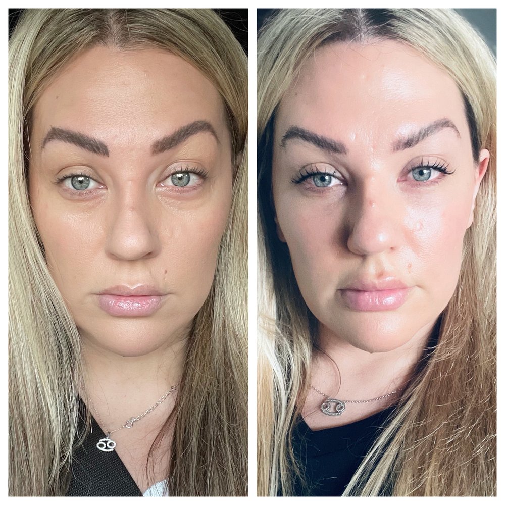 Lazer Lounge - Under eye filler and lip filler - Laser Hair Removal Near Me - Studio City, California Lazer Lounge - Under eye filler and lip filler - Laser Hair Removal Near Me - Studio City, California