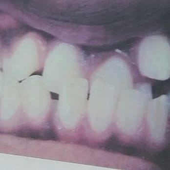 My Braces Doctor - Before - Orthodontists Near Me - Alexandria, Virginia My Braces Doctor - Before - Orthodontists Near Me - Alexandria, Virginia