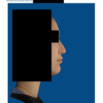Z. Paul Lorenc, MD, FACS - Less than 6 months post-op. INSANE - Cosmetic Surgeons Near Me - New York, New York Z. Paul Lorenc, MD, FACS - Less than 6 months post-op. INSANE - Cosmetic Surgeons Near Me - New York, New York