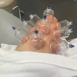Access Rehab Physical Therapy - Cupping