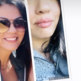 Lip filler/lip flip Lip filler/lip flip