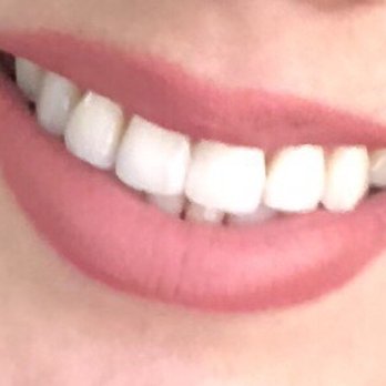 Michael S Capio, DDS - Dental Solutions - Best composite bonding ever. It looks even better in person. - General Dentistry Near Me - Los Angeles, California Michael S Capio, DDS - Dental Solutions - Best composite bonding ever. It looks even better in person. - General Dentistry Near Me - Los Angeles, California
