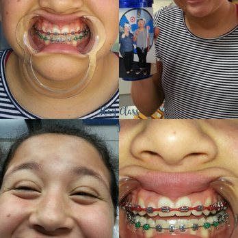 Humphries Orthodontics - After the 2 hour appointment - Orthodontists Near Me - Orange, California