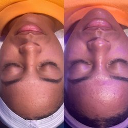 Nu Glow Esthetics - Before and after 1st "blemish be gone" acne facial