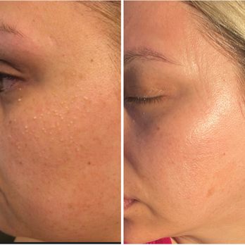 Skin Elevate - Acne Facial: before & after pictures - Skin Care Near Me - Newport Beach, California Skin Elevate - Acne Facial: before & after pictures - Skin Care Near Me - Newport Beach, California