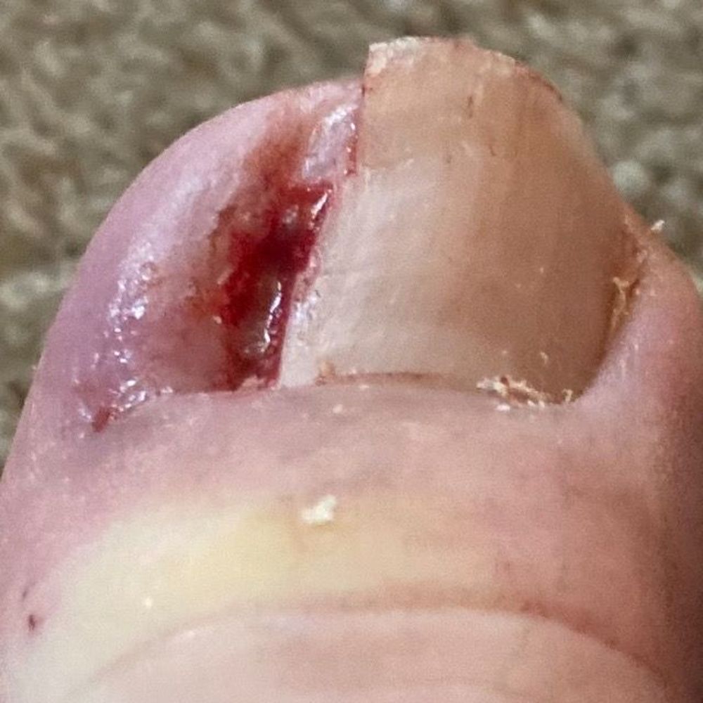 Was super aggressive with the toenail extraction. Was super aggressive with the toenail extraction.