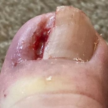 Exer Urgent Care - Beaumont - Was super aggressive with the toenail extraction. - Urgent Care Near Me - Beaumont, California