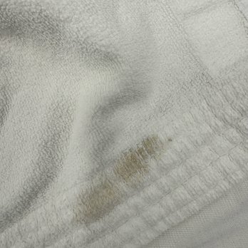 LaserAway - Large wet brownish spot! - Medical Spas Near Me - Rancho Mission Viejo, California