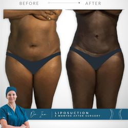 Evolution MD - Liposuction 3 months after surgery. Amazing results!!!