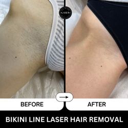All In One Laser