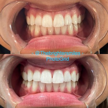 The Brighter Smiles - Before on top After on bottom - Dental Hygienists Near Me - San Jose, California The Brighter Smiles - Before on top After on bottom - Dental Hygienists Near Me - San Jose, California