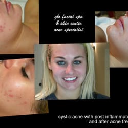 Glo Facial Spa & Skin Center