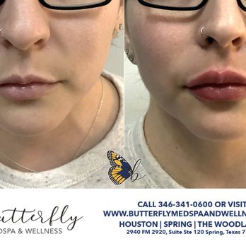 Butterfly MedSpa and Wellness - Before and after with Restylane Kysse - Medical Spas Near Me - Spring, Texas Butterfly MedSpa and Wellness - Before and after with Restylane Kysse - Medical Spas Near Me - Spring, Texas